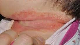 em bé bị hăm cổ 2